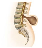 Менингоцеле (грыжа оболочек спинного мозга);