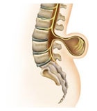 Миеломенингоцеле (spina bifida cystica — грыжа спинного мозга и мозговых оболочек);